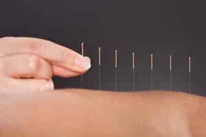 Pourquoi avoir recours à l'acupuncture